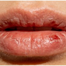 健康科普丨别让“干唇”变“唇炎”,冬季护唇自救宝典来啦!