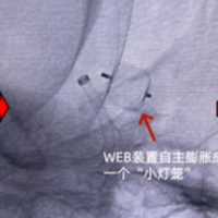 湘西州人民医院：“小灯笼”照亮生命禁区，脑动脉瘤治疗添利器