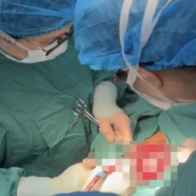 孕19周子宫“倒扣”伴巨大肿瘤 湖南医患同心创下“保胎奇迹”