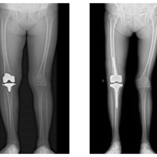 刀尖上的“关节保卫战”！郴州市第一人民医院一月连破3例复杂假体感染难题