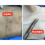 长沙泰和医院成功开展椎间孔镜下双节段髓核摘除联合纤维环缝合术