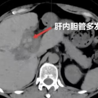 四次开腹跨省求医 微创技术破解肝胆顽疾