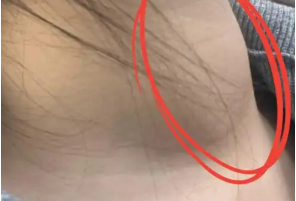 辟谣！补碘不会得甲状腺癌，青岛疾控专家这样说……