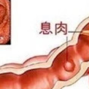 健康科普丨肠道里的“定时炸弹”,直肠息肉你不得不防