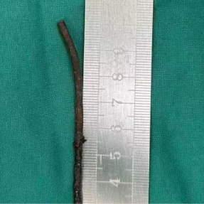 1岁幼儿左眼被钢筋刺入，南华附二医院眼科精准手术保光明
