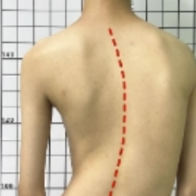 孩子高低肩、总喊腰酸背痛?这些可能是脊柱侧弯的信号
