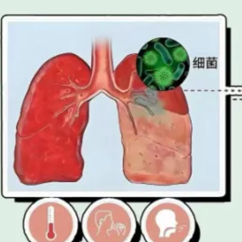 女子咳嗽经久不愈,竟是鸽群暗藏真菌引发肺部感染