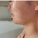 35岁患者颌下唾液腺藏1厘米结石 邵阳学院附属第一医院微创取石实现“保腺无痕”