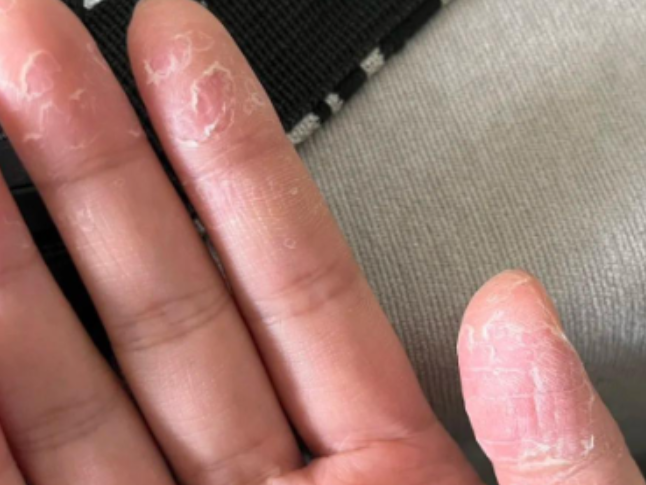 手脚脱皮，说明缺乏维生素？