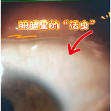 永州市第四人民医院眼科成功取出罕见“眼内活虫”,女子左眼累计寄生9条线虫