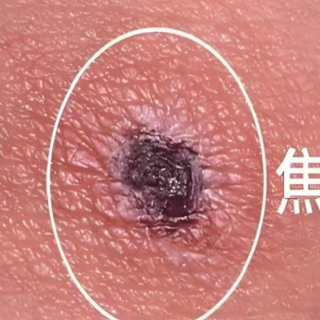 头上藏着小黑痂女子住进ICU!夏季户外活动谨防这种“小虫子”