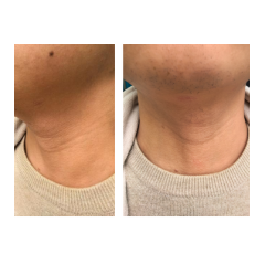 怀化市肿瘤医院解锁甲状腺手术隐形愈合新方案