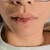 唇间黑斑别忽视 双镜联合救治少年患者