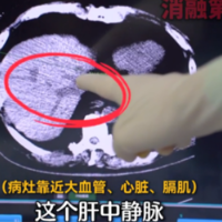 两处肝癌“雷区”一次清除,被婉拒的64岁患者在长沙迎来转机