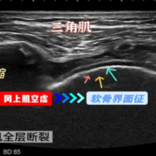 肌骨超声“揪”出隐匿病灶 中西协同为透析患者解数年顽痛