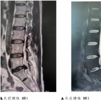 一声咳嗽后他走不了路了 医生提醒：这种腰腿痛别硬扛