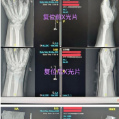 粉碎性骨折，也能中医手法复位？