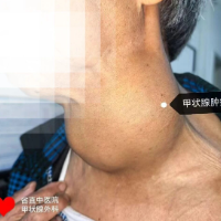 多学科协同闯难关 湖南省直中医医院为八旬老人摘除颈部巨大肿瘤