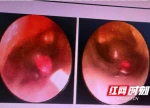 3 岁女童双耳塞入3颗水钻！家长记住：耳朵里这些东西越掏越危险