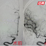 永州市中医医院脑病科连续成功实施大脑中动脉球囊扩张术