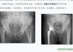 走路摇摆20多年！专家提醒：这种“长短腿”别硬扛