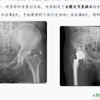 走路摇摆20多年！专家提醒：这种“长短腿”别硬扛