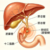 健康科普 | 儿童也会患上胆管结石，这些信号别忽视
