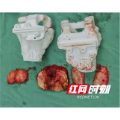 郴州市第四人民医院：定制3D打印截骨导板化解复杂手术难题