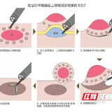郴州市第四人民医院：内镜“狙击”胃早癌，ESD手术免切胃解患者之忧