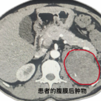 体内藏两处巨大肿瘤浑然不知 多学科协作精准切除