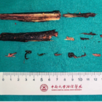 大爷摔倒被7厘米树枝刺入眼眶,湘雅医院多学科协作成功“拔刺”