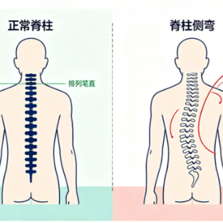 脊柱侧弯成年后就没办法了？专家：需个性化干预、忌乱矫正