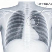 健康科普 | 体检胸片正常，胸部CT却查出肺结节？