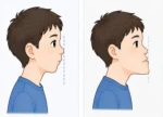 全国爱牙日 | 孩子换牙期牙齿不齐，是等换牙结束还是尽早干预？
