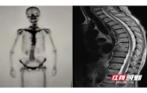 南华医院罕见病门诊精准确诊SAPHO综合征，患者多年病痛终得缓解