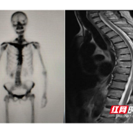 南华医院罕见病门诊精准确诊SAPHO综合征，患者多年病痛终得缓解