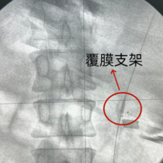 娄底市第二人民医院微创技术解决复杂输尿管狭窄难题