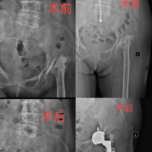 永州市中心医院：高难度全髋关节置换术助五十年跛行患者重获“新生”