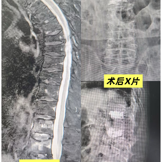 95岁老人脊柱骨折 湘仁医院微创手术助其3天顺利下床出院