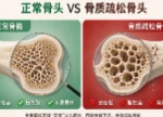 世界骨质疏松日丨骨质疏松，到底能不能“治好”？