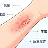 健康科普 | 换季荨麻疹高发,科学应对这些信号别忽视