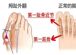 拇外翻不只是美观问题，不要拖到膝盖腰背痛才就医