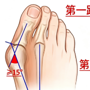 拇外翻不只是美观问题,不要拖到膝盖腰背痛才就医