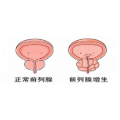 世界男性健康日｜前列腺增生莫忽视，别让排尿预警被当成衰老